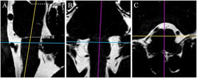 The Distance Between the Cranial Nerve IX-X Root Entry/Exit Zone and the Pontomedullary Sulcus: MR Imaging Study in Patients With Hemifacial Spasm